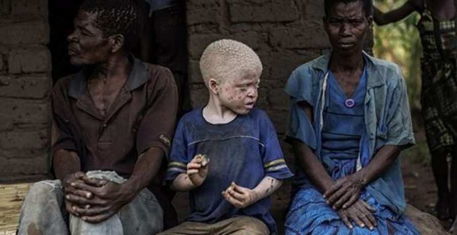 Misteri i fëmijëve albin në Afrikë, vriten për të shitur eshtrat e tyre, një trup vlen 75 mijë euro