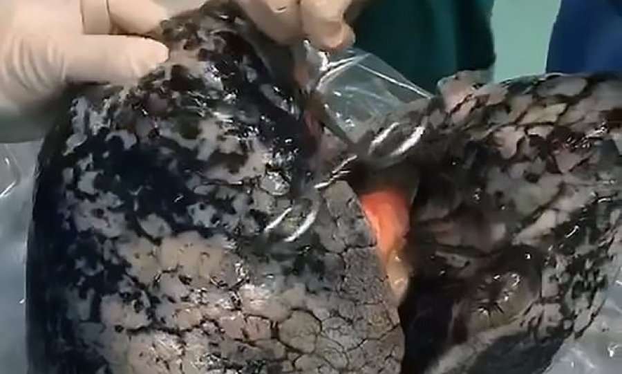 Mushkëritë e duhanpirësit që pinte një pako çdo ditë për 30 vjet