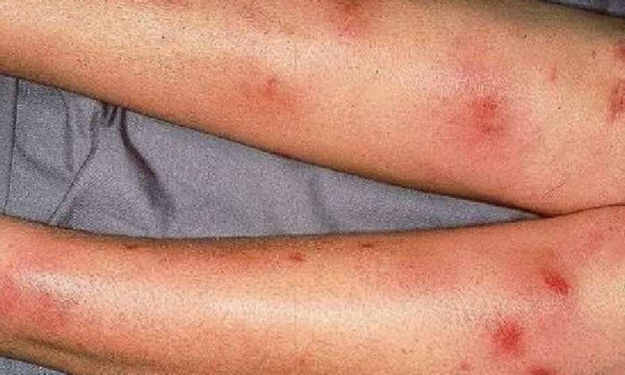 Studim: Skuqja në këmbë tregon se është simptomë e COVID-19, që ndikon në enët e gjakut