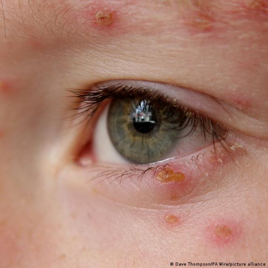 Pse është e rëndësishme vaksina kundër lisë së pyllit?