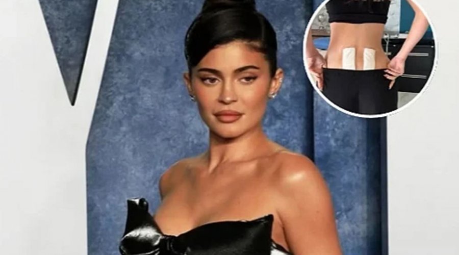 Kylie Jenner zbuloi se iu nënshtrua terapisë me qeliza staminale për të lehtësuar dhimbjet e shpinës pas lindjes