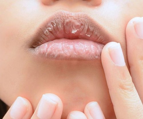 Katër arsyet pse i keni buzët e plasaritura gjatë dimrit