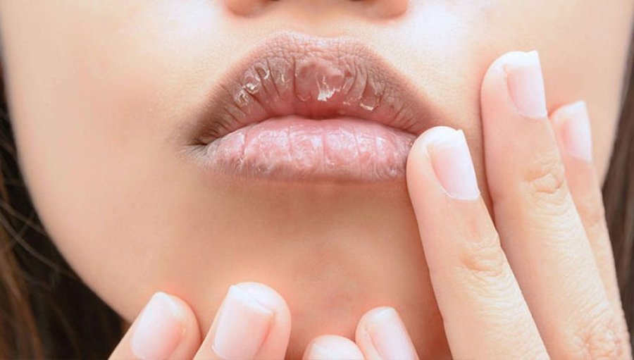 Katër arsyet pse i keni buzët e plasaritura gjatë dimrit