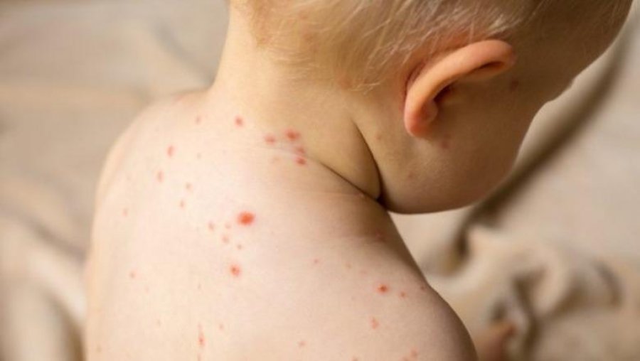 18 raste me fruth në Shqipëri, përgjatë vitit 2025