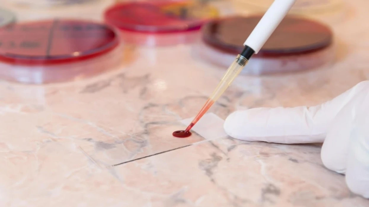 Shenjat e hershme në gjak, si të zbulohet skleroza multiple përpara se të shfaqen simptomat