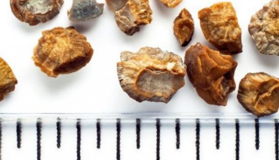 Kështu e kuptoni nëse keni gurë në veshkë