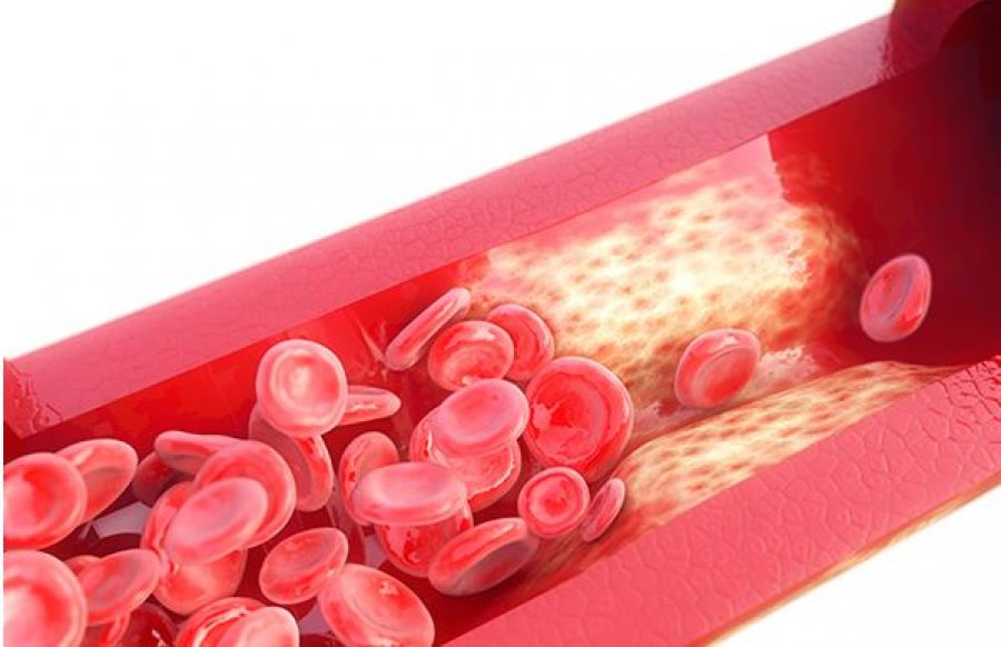 Hipertensioni, shkaqet, diagnostikimi dhe trajtimi i tij