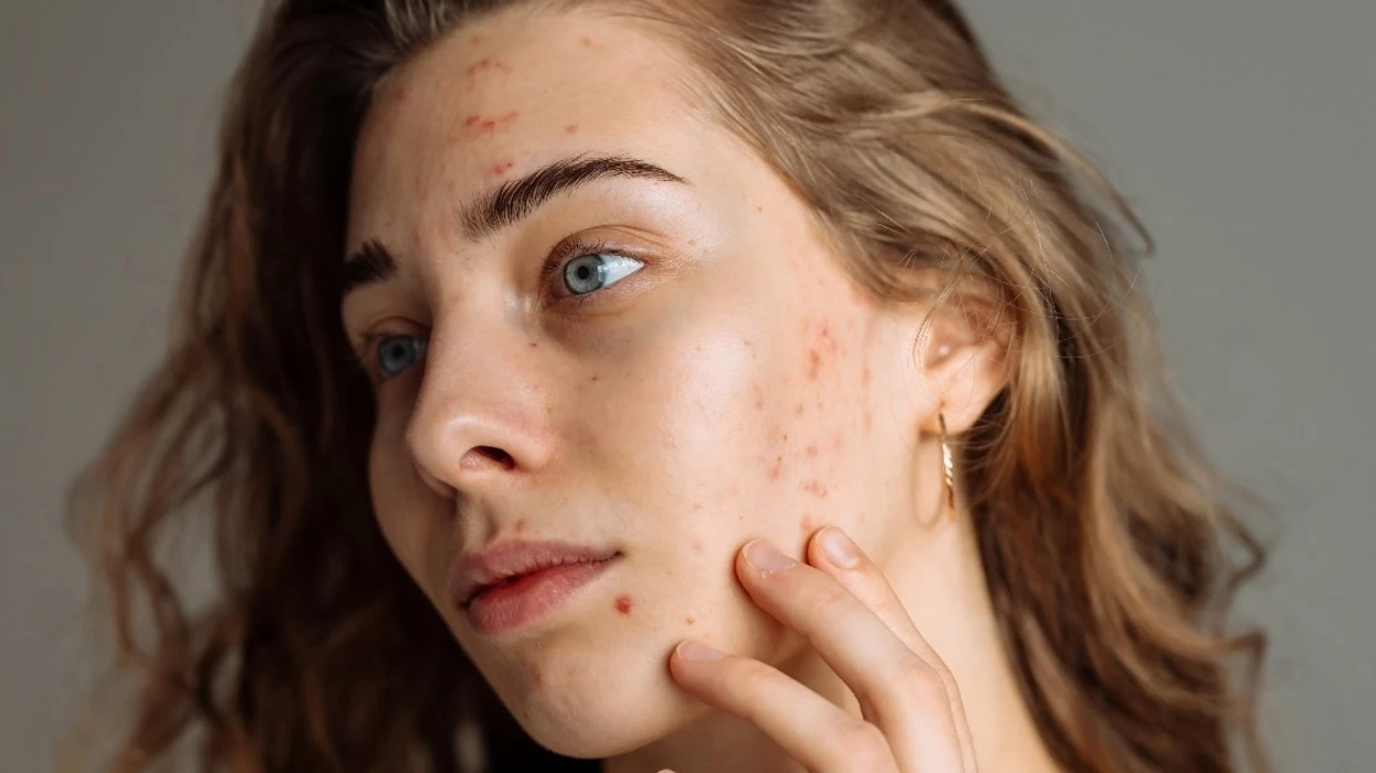 A vuani nga aknet, ankthi dhe urthi? Shkaku mund t’ju habisë