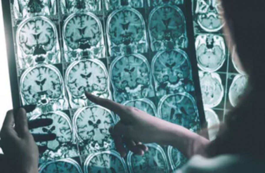 Vdekshmëria nga goditja në tru në Zvicër është përgjysmuar në 20 vitet e fundit