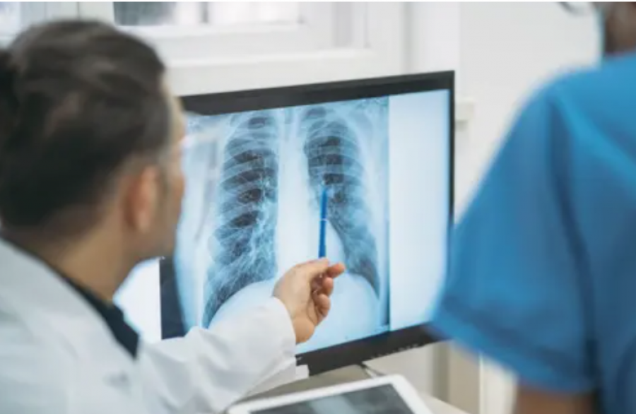 Inteligjenca artificiale ndihmon në zbulimin e hershëm të kancerit të mushkërive