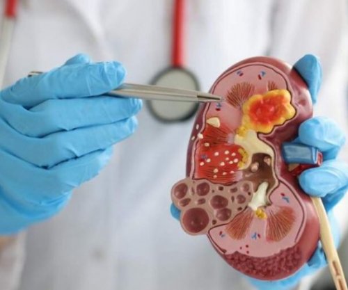 Përfituan 134 mijë euro duke mashtruar për transplantim veshke, aktakuzë ndaj dy personave në Pejë