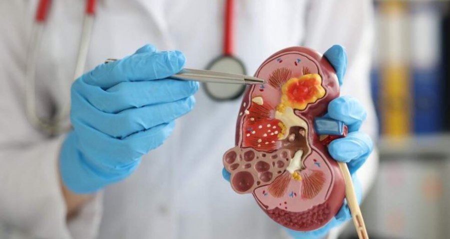 Përfituan 134 mijë euro duke mashtruar për transplantim veshke, aktakuzë ndaj dy personave në Pejë