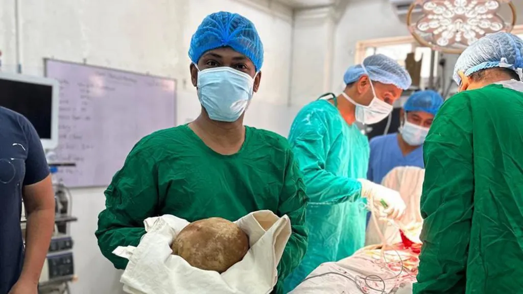 Mjekët në Sri Lanka heqin gurin 3.1 kilogramësh nga fshikëza e një 55-vjeçari