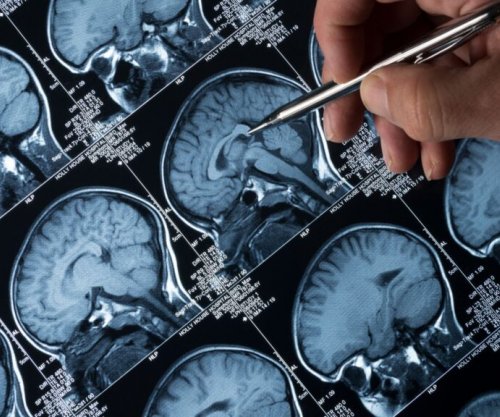 Shkencëtarët shohin për herë të parë dëmtimin e trurit nga Alzheimeri në kohë reale