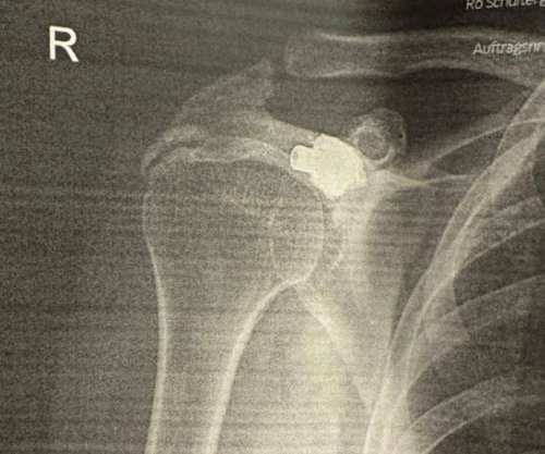 “Plumbi që mbijetoi 27 vjet në trupin tim”, rrëfimi i Gramoz Berishës në 18-vjetorin e Pavarësisë