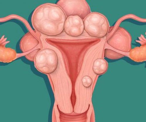 Çfarë janë fibromat e mitrës dhe ja çfarë duhet patur parasysh