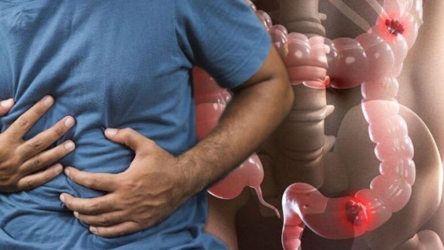 Gastroenterologu kosovar: Kanceri i zorrës së trashë mund të zhvillohet pa asnjë simptomë