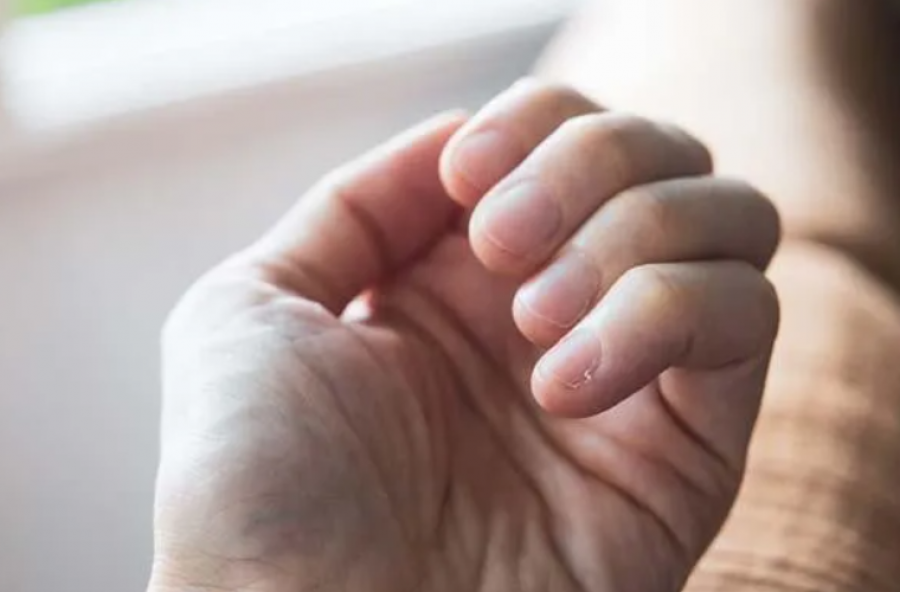 Pesë shenja që jua japin duart kur keni problem me tiroiden