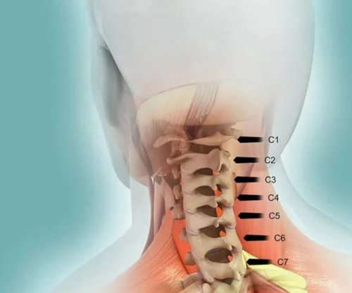 Lëndimet më të rënda të palcës kurrizore: Kur dëmtohen dy rruazat e qafës, pasojat mund të jenë fatale