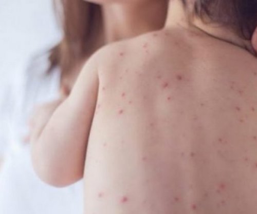 Rritet interesimi për vaksinim kundër fruthit, mbi 1 mijë doza të dhëna në Prishtinë gjatë majit