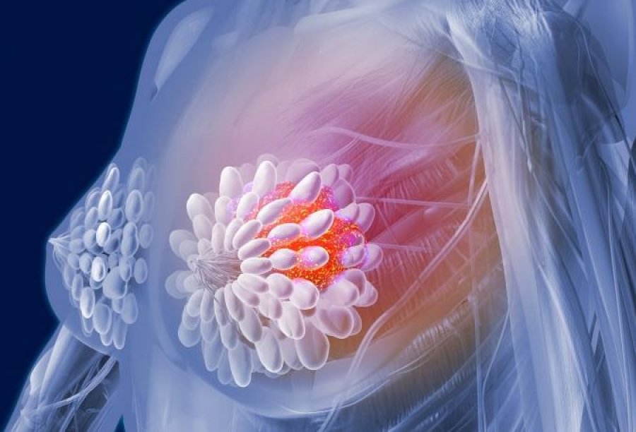 Vajrat e farave lidhen me rritjen e një lloji shumë agresiv të kancerit të gjirit