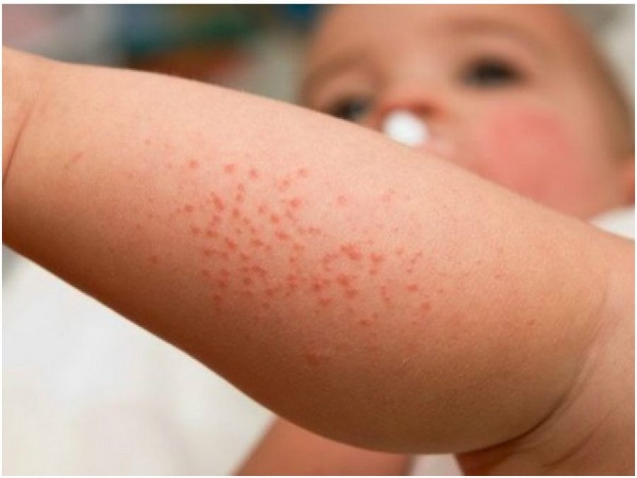 Mjekët paralajmërojnë për rritjen e alergjive ushqimore te fëmijët