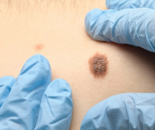 Dermatologët në Maqedoni zbulojnë raste të dyshimta të kancerit të lëkurës gjatë kontrolleve falas