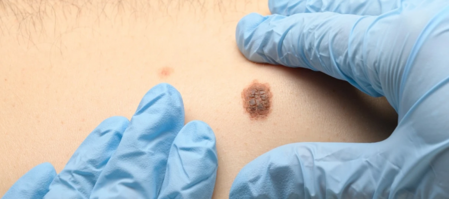 Dermatologët në Maqedoni zbulojnë raste të dyshimta të kancerit të lëkurës gjatë kontrolleve falas